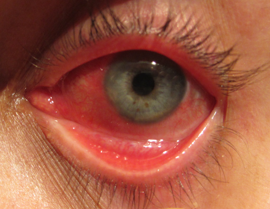 Ardor en los ojos